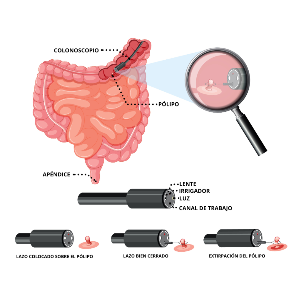 Polipectomia precio Colonoscopia Queretaro