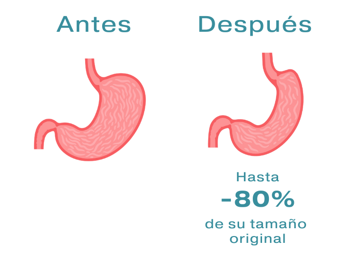 Manga gastrica endoscopica Queretaro